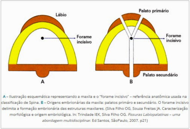 classificação das fissuras